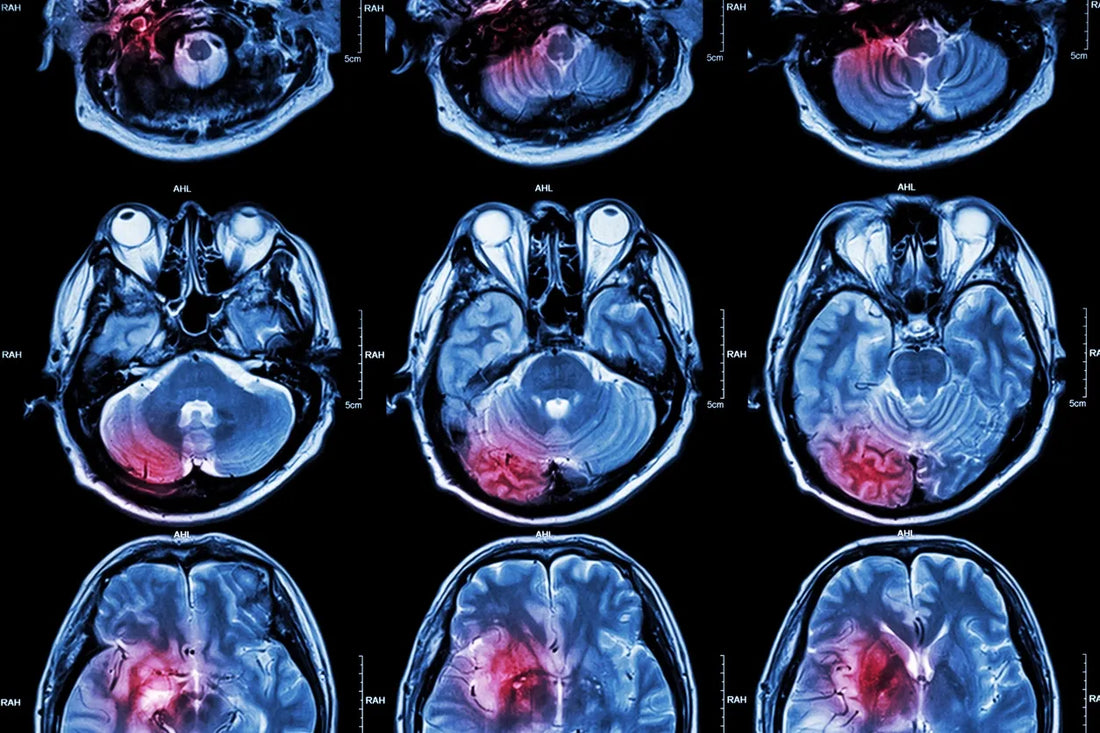 Neuroinflammation And Biomarkers For Suicide Risk